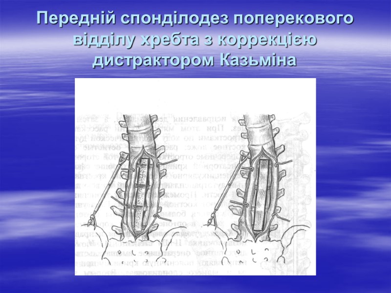 Передній спонділодез поперекового відділу хребта з коррекцією дистрактором Казьміна